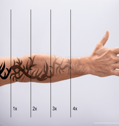 Tattoo Removal